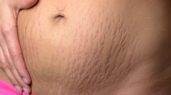 Cara Mencegah Stretch Mark saat Hamil agar Kulit Tetap Sehat