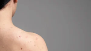 Bekas Jerawat di Tubuh vs di Wajah: 