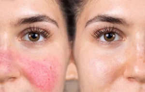 Perbedaan Jerawat Biasa dan Rosacea: