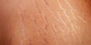 Cara Mengatasi Stretch Mark (Strie) di Paha dan Perut