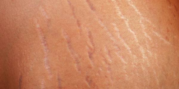 Cara Mengatasi Stretch Mark (Strie) di Paha dan Perut